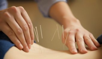 Acupuncture for Back Pain – What you Need to Know